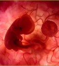 aborto